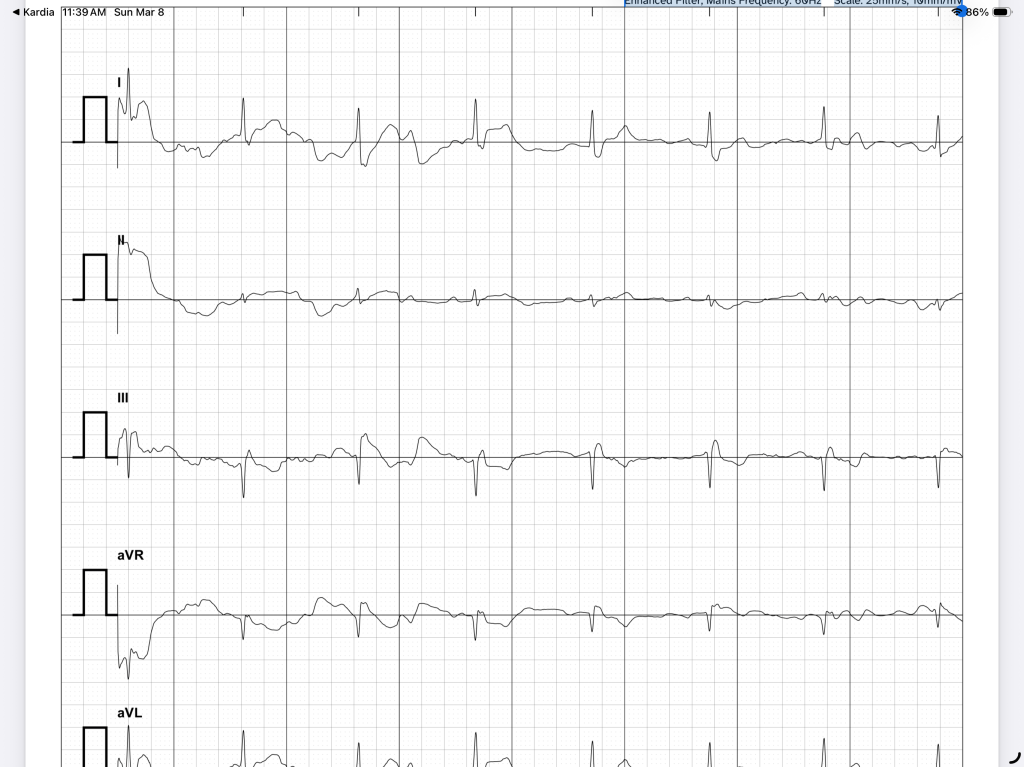 Electrocardiogram (ECG) reading displaying six leads: I, II, III, aVR, aVL, and aVF with waveforms indicating heart activity.